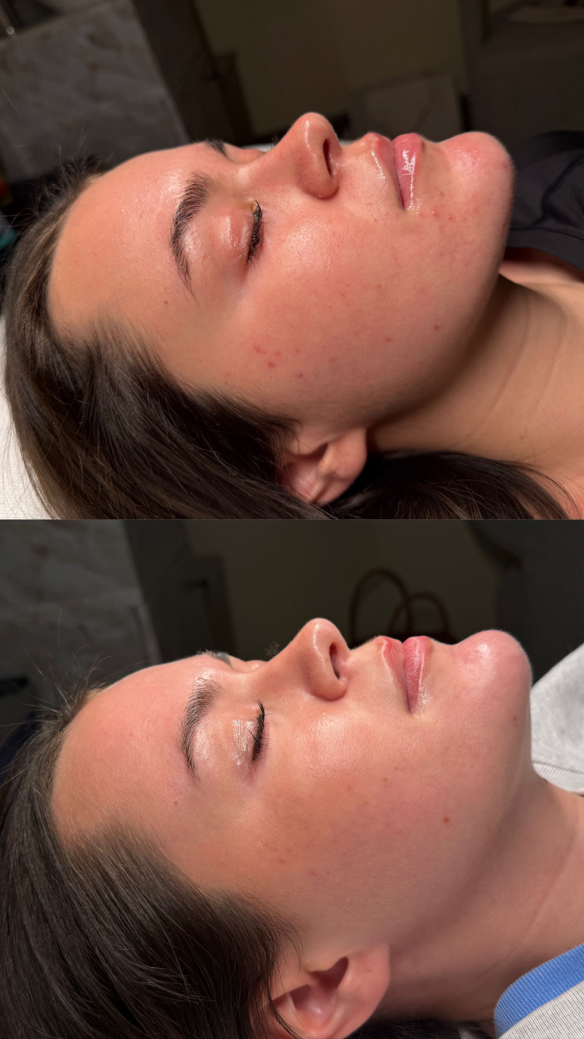 Acne Solutions Designed for Long-Term Results